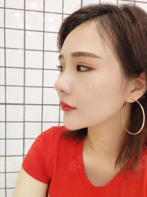 今天花了眼妆,恢复很好,不影响了眼睛大很多呀,看...眼型矫正悦美整形