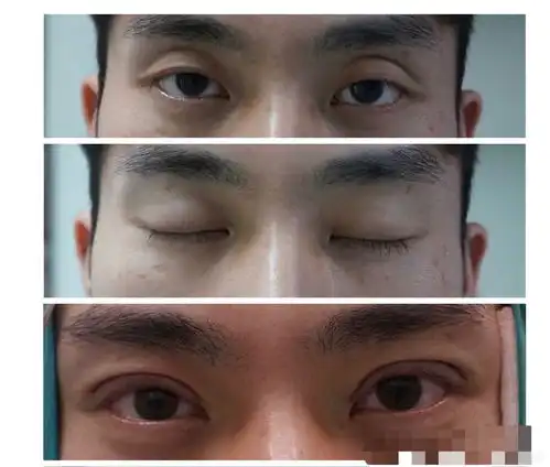 请问北京哪里割双眼皮好呢,有没有推荐呢