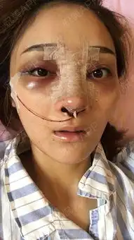 美莱自体内软骨手术当天,肿肿肿因为7年...鼻综合悦美整形