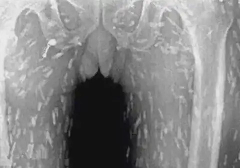 女子因吃了生鱼片全身发痒,看到x光照片后连医生都浑身发痒