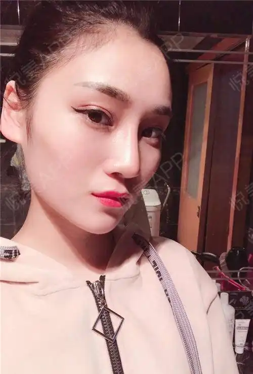 眼妆是花的越来越好了,有时候还误以为自己是做的双眼...面部填充悦美整形