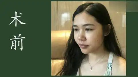 做完鼻子,都说我老了10岁,显得很凶