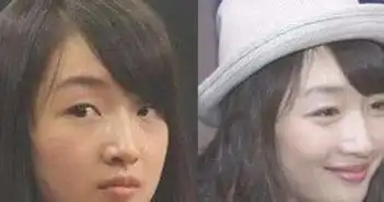 解开割双眼皮的七大疑惑