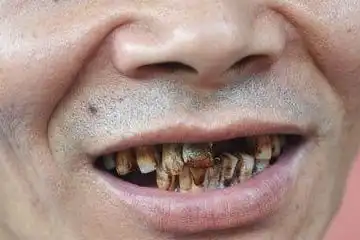 一白遮百丑,牙黄毁所有只需做好这几点,教你告别大黄牙