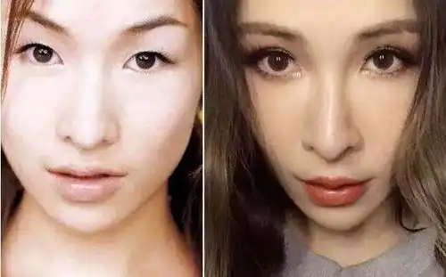 苏州双眼皮医生整理分享