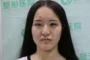 妈妈的朋友是...双眼皮悦美整形