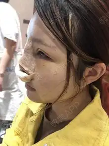 不仅仅做了鼻子脸上贴的胶布是做了脂肪填充的,我觉得...自体脂肪悦美整形
