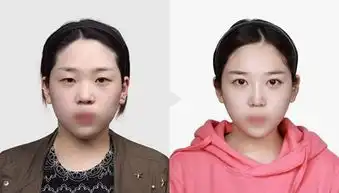 做双眼皮全切好还是埋线好,手术多长时间