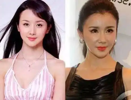 这些被玻尿酸毁了的女明星
